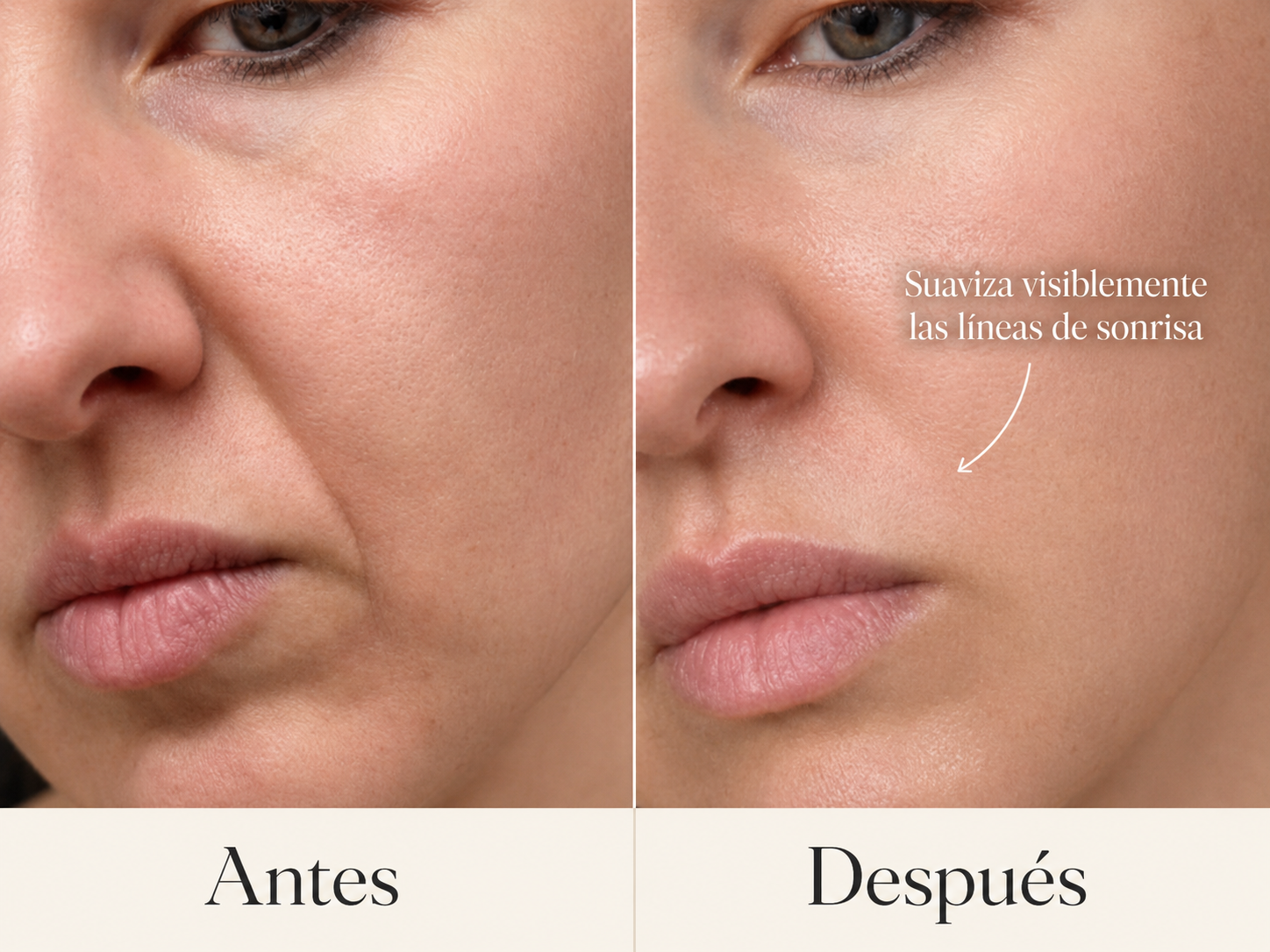Antes y después: líneas de sonrisa